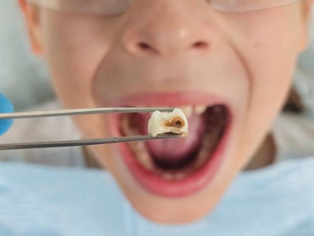 Best Emergency Root Canal Treatment in Pana, IL